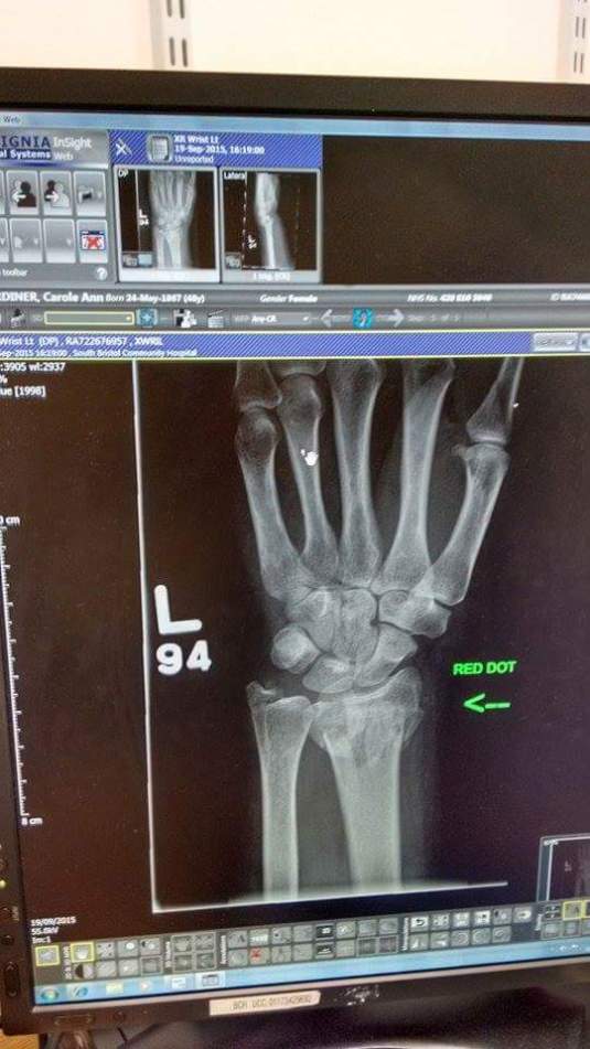 wrist xray